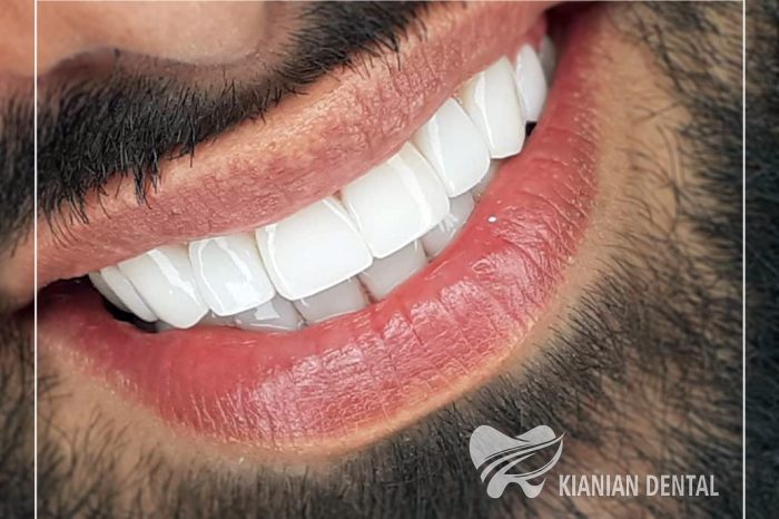 کلینیک دندانپزشکی کیانیان, لیرینگ دندان,ایمپلنت دندان,بلیچینگ دندان,