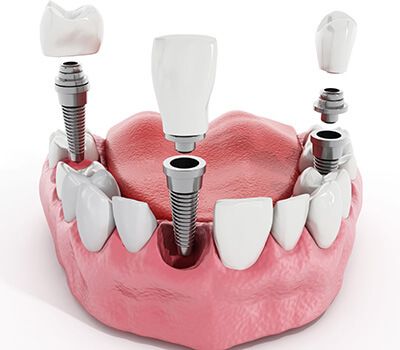 کلینیک دندانپزشکی کیانیان, لیرینگ دندان,ایمپلنت دندان,