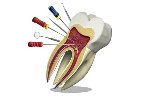 درمان ریشه دندان , عصب کشی دندان