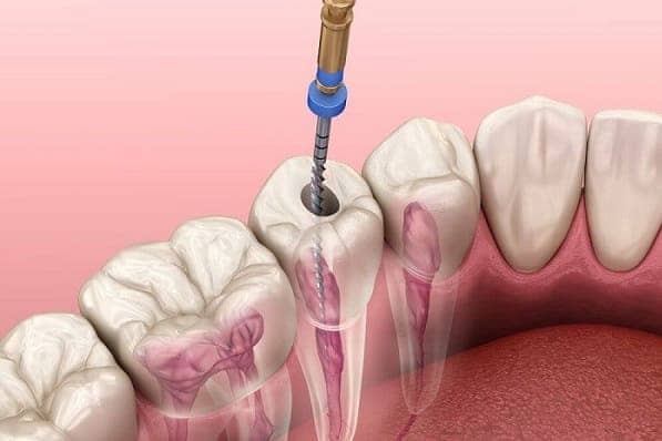 عصب کشی دندان در جردن و ونک