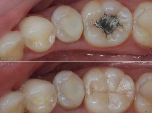 درمان ریشه دندان , عصب کشی دندان