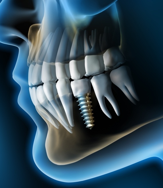 کلینیک دندانپزشکی کیانیان, لیرینگ دندان,ایمپلنت دندان,انجام ایمپلنت دندان