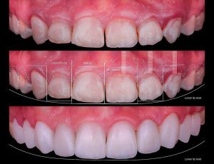 کلینیک دندانپزشکی کیانیان, لیرینگ دندان,ایمپلنت دندان,بلیچینگ دندان,لمینت دندان,کامپوزیت ونیر دندان,لمینت سرامیکی دندان