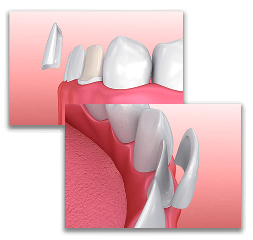 کلینیک دندانپزشکی کیانیان, لیرینگ دندان,ایمپلنت دندان,بلیچینگ دندان,لمینت دندان,کامپوزیت ونیر دندان,