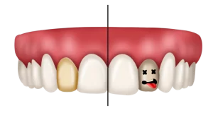 بلیچینگ دندان 