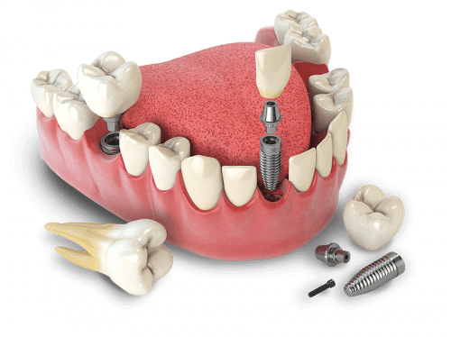 کلینیک دندانپزشکی کیانیان, لیرینگ دندان,ایمپلنت دندان,